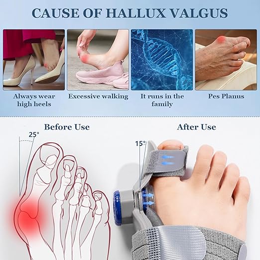 FeetifFix™ Bunion Corrector – Relieve Pain & Realign Naturally