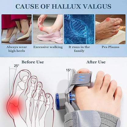 FeetifFix™ Bunion Corrector – Relieve Pain & Realign Naturally